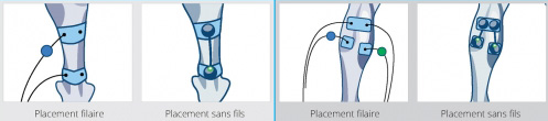 placement electrodes-tendinopathie tendon achille